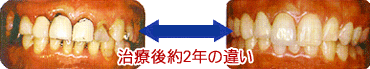 硬質レジンとメタルボンドクラウンの2年後の違い