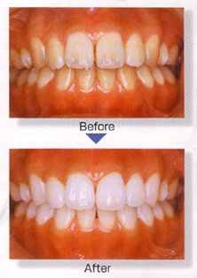 �z���C�g�j���Obefore��after