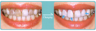 �ϐF�������R�Ȕ�����before��after