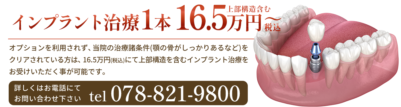 神戸 インプラント治療1本22万円