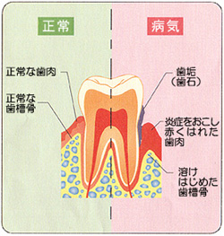 歯周病治療は神戸市灘区の歯科医院 歯医者 うしじま歯科クリニックへ
